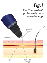thermavein-how-it-works